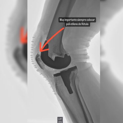 Ortopedia Geri Trica Cirug A Articular Pr Tesis De Rodilla Dr Jose