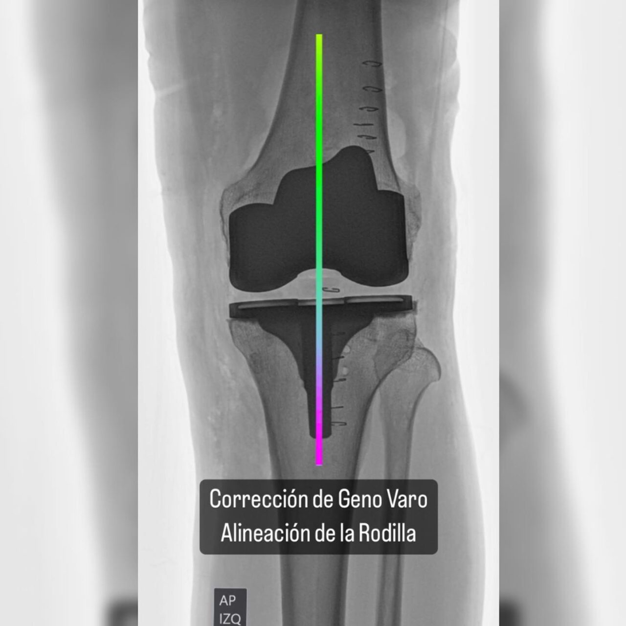 Ortopedia Geri Trica Cirug A Articular Pr Tesis De Rodilla Dr Jose