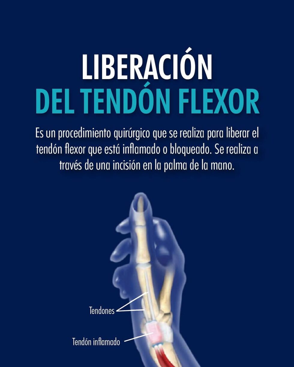 Liberación del Tendón Flexor Dr Jose Mario Dorantes Rodríguez