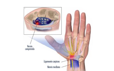 Cirugía del Túnel Carpiano