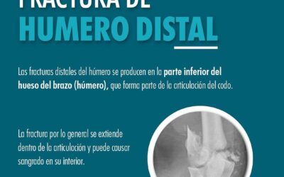 Factura de Humero Distal